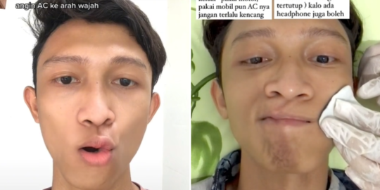 Viral Pria Alami Kelainan Otot pada Wajahnya, Ternyata Ini Penyebabnya