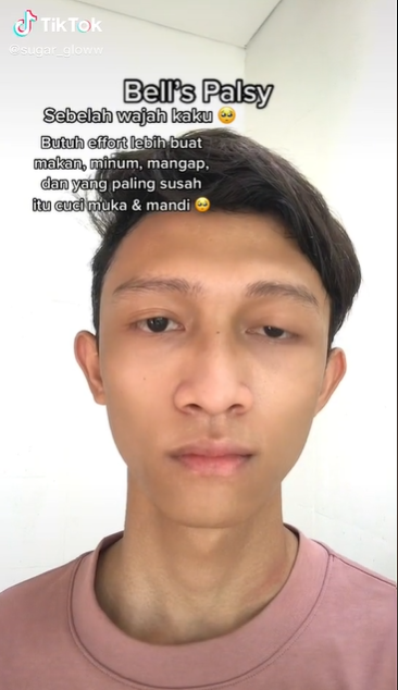 viral pria ini alami kelainan otot pada wajahnya ternyata ini penyebabnya