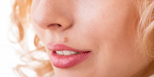 Mengenal Cherry Angioma, Tahi Lalat Merah yang Jarang Diperhatikan