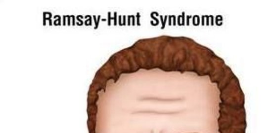 Perbedaan Ramsey Hunt Syndrome dan Bell's Palsy, Gejala Lebih Parah