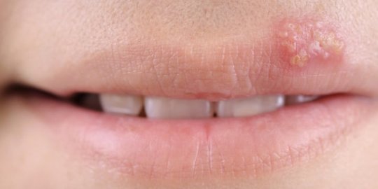 3 Penyebab Herpes Kulit Beserta Gejala & Faktor Risikonya, Jangan Dianggap Sepele