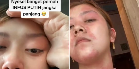 Viral, Wanita Ini Didiagnosis Autoimun Usai Rutin Gunakan Infus Putih