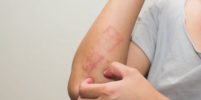Gejala Dermatitis Atopik yang Mudah Dikenali, Waspadai Penyebabnya