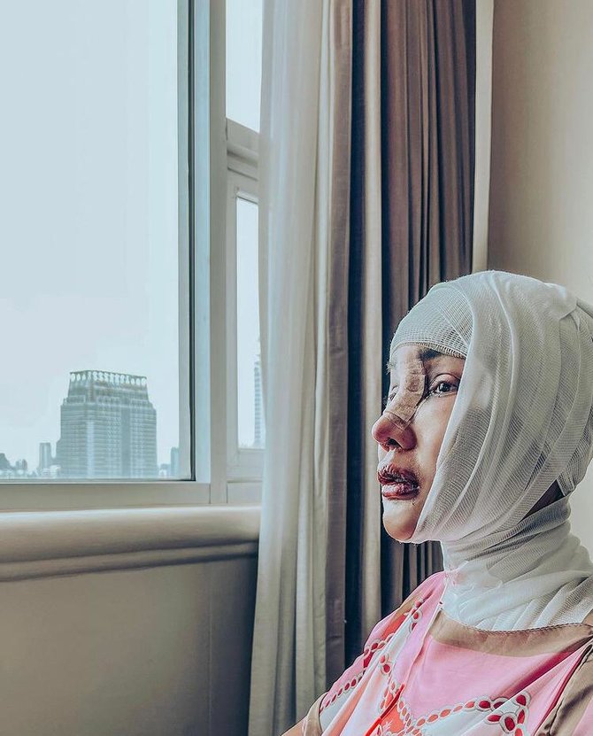 lucinta luna operasi potong leher
