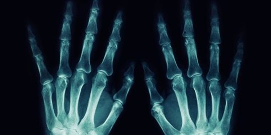 Penyebab Osteomalacia yang Perlu Diwaspadai, Kondisi yang Sebabkan Tulang Melunak