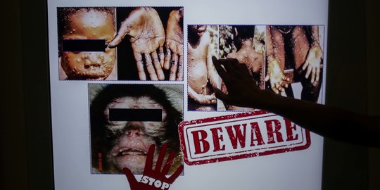 Satgas Monkeypox IDI: Belum Ditemukan Kasus Cacar Monyet di Indonesia