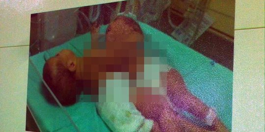 Penyebab Bayi Kembar Siam, Kenali Gejala dan Penanganannya