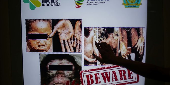 Kemenkes: Sampel Oropharings Pasien Suspek Monkeypox di Jateng Negatif
