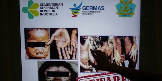 Asal-usul, Gejala dan Riwayat Monkeypox