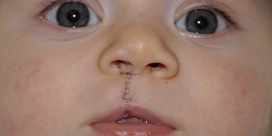 Ibu Hamil Wajib Tahu, Ini Penyebab Bibir Anak Sumbing saat Dilahirkan
