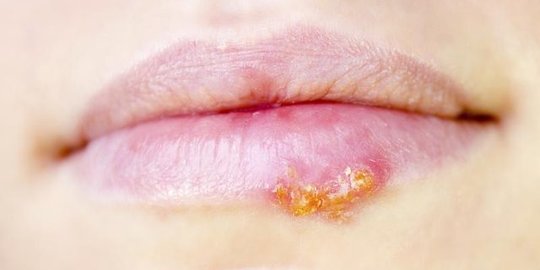 Penyebab Herpes di Wajah yang Perlu Diketahui dan Cara Mengobatinya