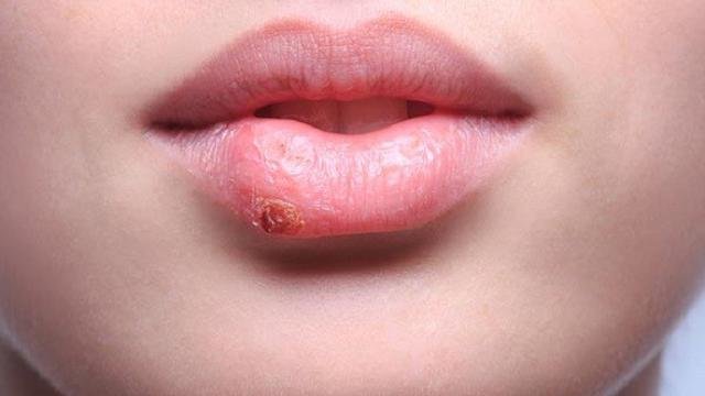 cara mengatasi herpes