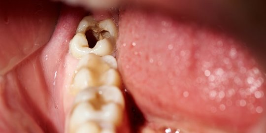 Kondisi Mulut yang Kurang Bersih Merupakan Penyebab Masalah Gigi Berlubang