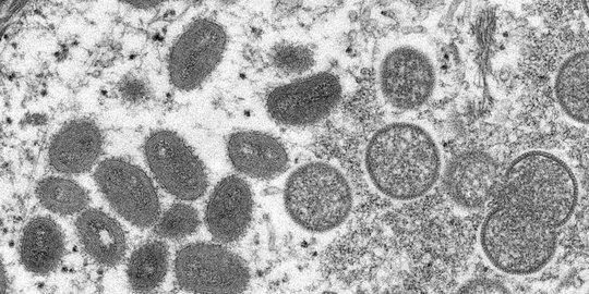 Nakes Dituntut Tingkatkan Kemampuan Klinis Diagnosis Monkeypox