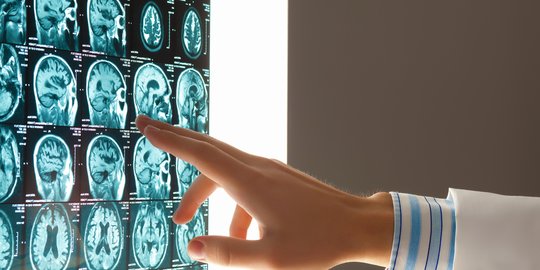 Tanda-Tanda Kanker Otak yang Perlu Diwaspadai, Begini Cara Mencegahnya