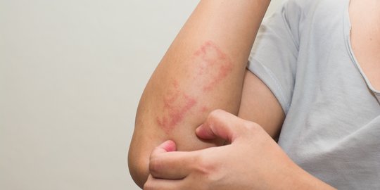 Gejala Dermatitis Numularis dan Penyebabnya, Ketahui Pengobatannya