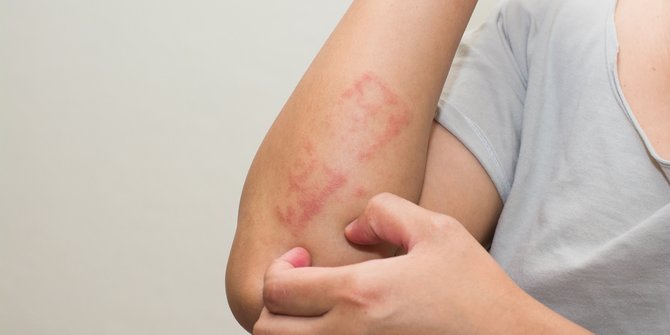 Gejala Dermatitis Numularis Dan Penyebabnya Ketahui Pengobatannya Merdeka Com