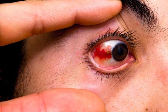 10 penyebab mata merah yang sering diabaikan