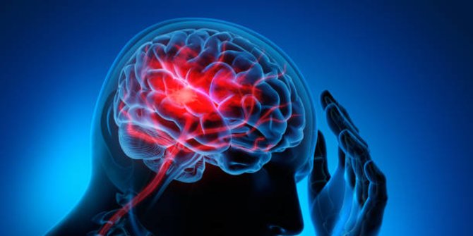 Waktu, Faktor Penting dalam Penanganan Stroke