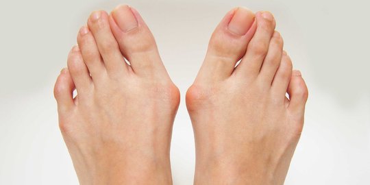 Mengenal Bunion dan Penyebabnya, Benjolan Tulang pada Jari Kaki