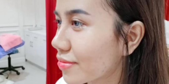 Potret Terbaru Mayang Usai Perban Hasil Oplas Dilepas, Hidung Mancung Bikin Pangling