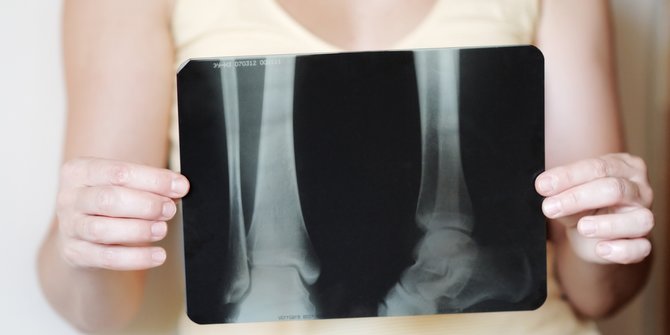Gejala Osteoporosis Paling Umum yang Penting Diketahui, Jangan Anggap Sepele