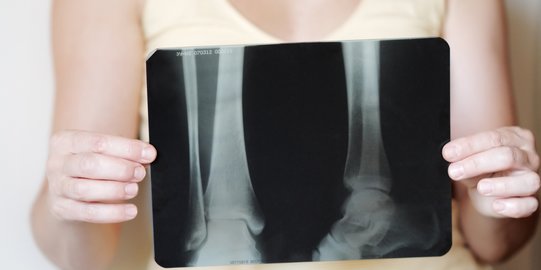 Osteoporosis Bisa Dicegah dengan Menerapkan Pola Makan yang Tepat