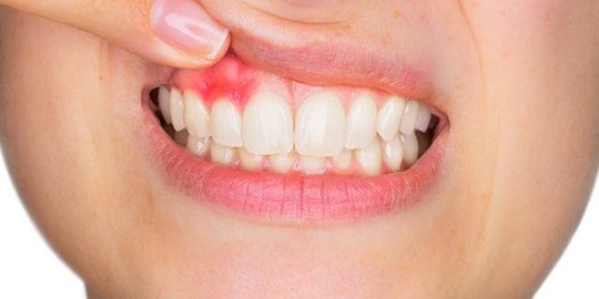 Gejala Periodontitis yang Tak Boleh Disepelekan, Perhatikan Gusi yang Sering Berdarah