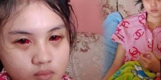 Lumpuh dan Hilang Ingatan, Begini Perjuangan Korban Tragedi Kanjuruhan Pulihkan Diri