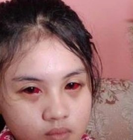 begini nasib cahayu gadis cilik korban kanjuruhan mata memerah sampai hilang ingatan