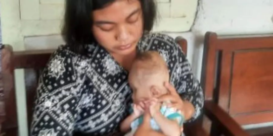 Bayi Derita Penyakit Meningokel, Tak Punya Tempurung Kepala Berat Badan Susah Naik