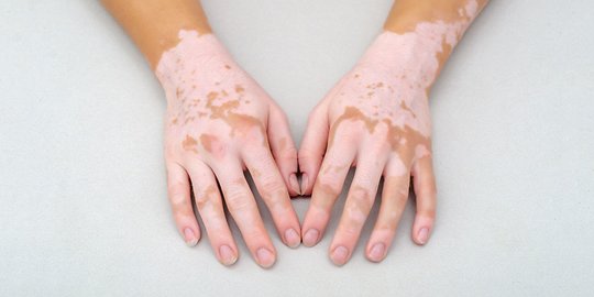 Gejala Vitiligo pada Anak dan Orang Dewasa, Ketahui Penyebabnya