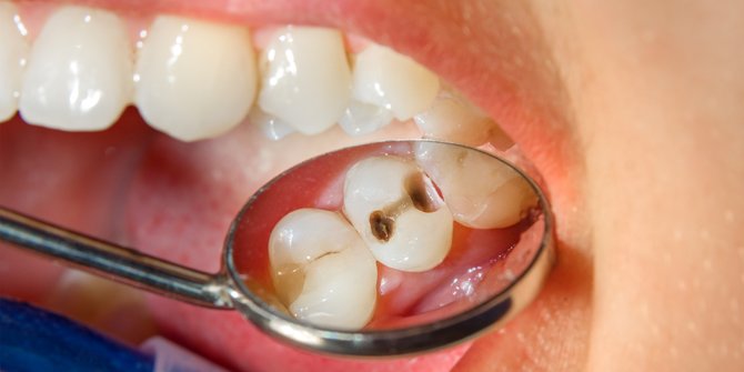 Punya Gigi Berlubang? Ketahui Penyebab dan Cara Tepat Mengatasinya