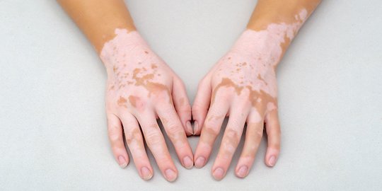 Penyebab Vitiligo Dan Faktor Risikonya Hilangnya Warna Kulit Yang