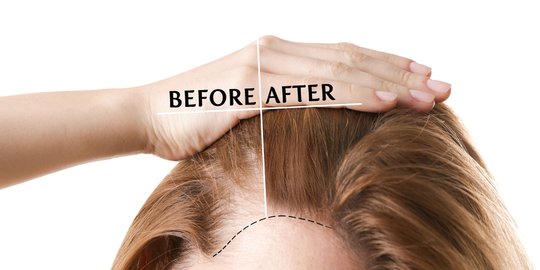 sebagai cangkok dan tanam rambut