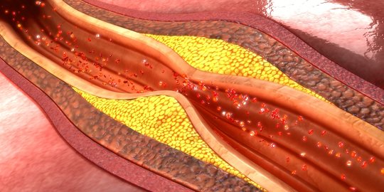 Gejala Aterosklerosis dan Faktor Risikonya, Penyempitan Arteri oleh Plak