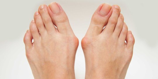 Sering Pakai Sepatu Berujung Lancip dan Sempit Bisa Munculkan Bunion