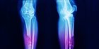 Gejala Osteosarkoma pada Anak, Jenis Kanker Tulang yang Perlu Diwaspadai