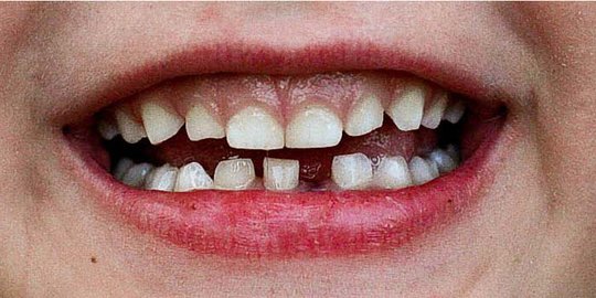 Penyebab Gigi Anak Rusak, Ketahui Cara Mencegah dan Merawat Agar Kembali Sehat