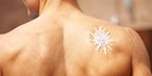 Mengenal Melanoma dan Gejalanya, Jenis Kanker Kulit karena Paparan Sinar Matahari