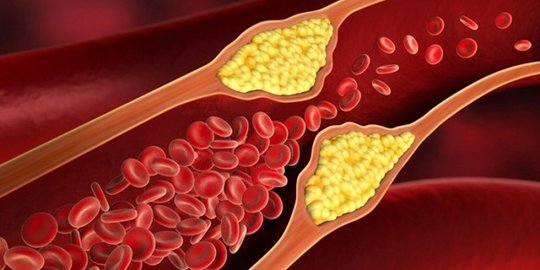 Mengenal Hiperlipidemia Dan Penyebabnya Peningkatan Kadar Lemak Dalam