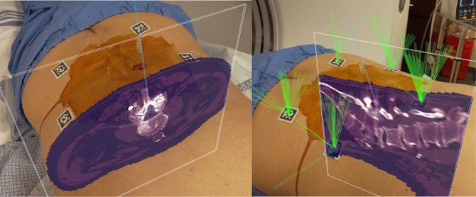 pertama di asia augmented reality ar diterapkan dalam operasi tulang belakang