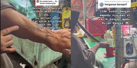 Penuh Luka, Begini Penampakan Tangan Ibu Sang Penjual Darah Ular