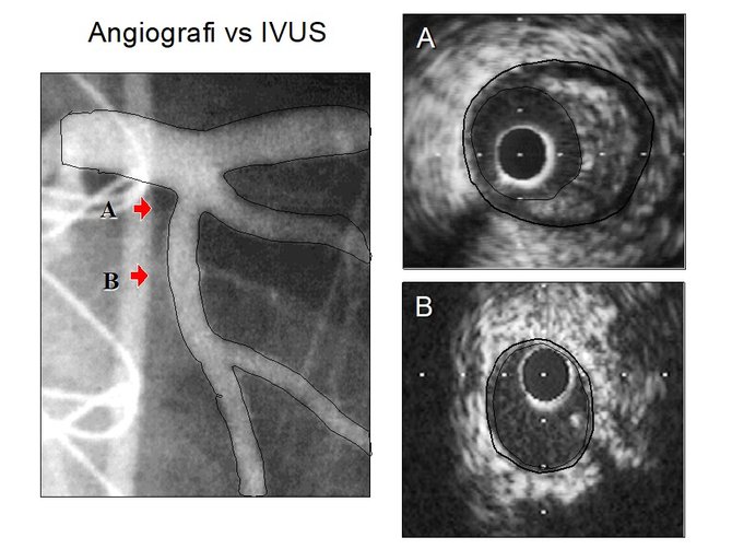 mengenal ivus inovasi medis untuk atasi pembuluh darah jantung koroner