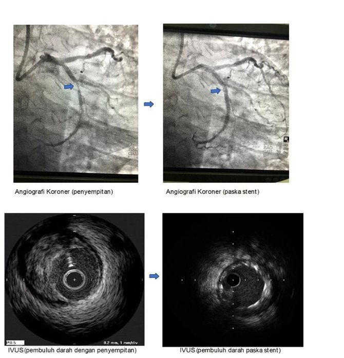 mengenal ivus inovasi medis untuk atasi pembuluh darah jantung koroner