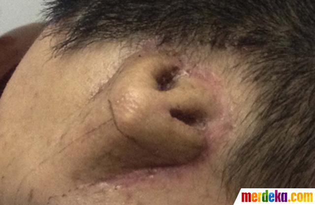 Foto : Pria ini miliki hidung baru di dahi merdeka.com