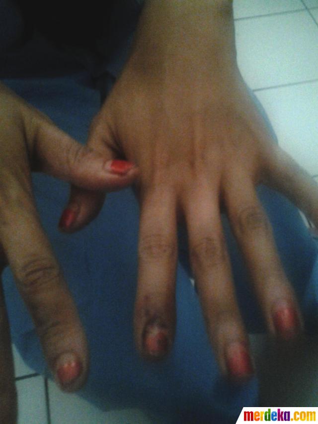 Foto Ini Luka Novi Amalia Saat Coba Bunuh Diri Merdeka Com