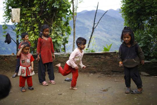 Kisah keluarga di Nepal penderita sindrom manusia serigala