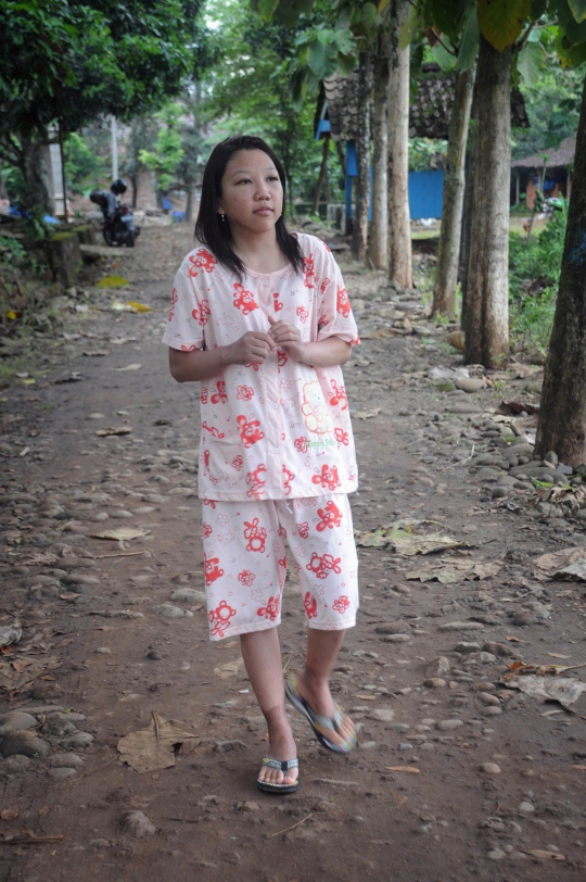 Menengok kondisi Erwiana, TKW korban aniaya majikan di Hong Kong