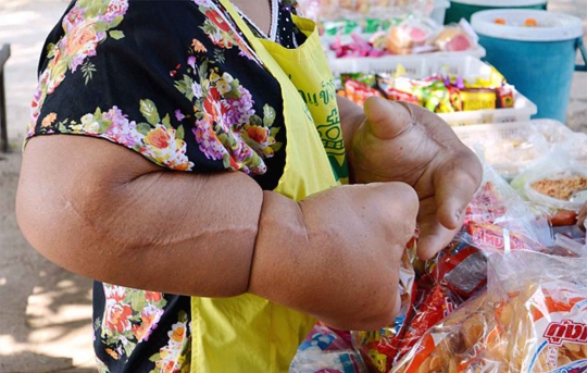 Ini wanita Thailand yang punya tangan raksasa